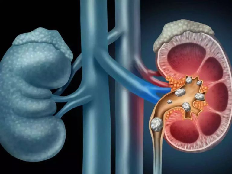 7 Tips Mengidentifikasi Gejala Awal Gangguan Ginjal
