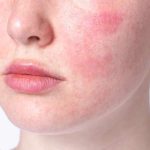 Perawatan Kulit Sensitif: 5 Tips Agar Kulit Tetap Sehat Tanpa Iritasi