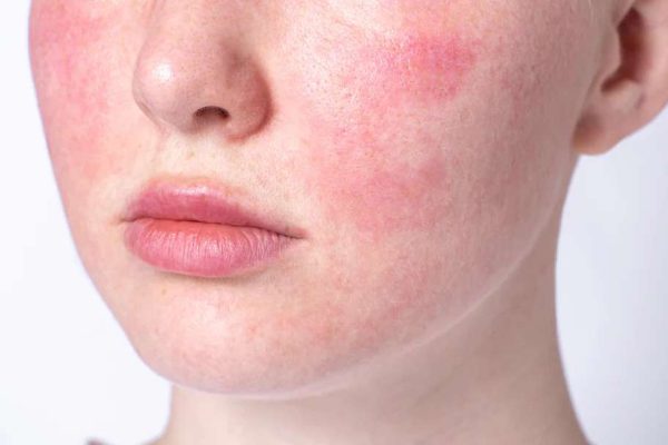 Perawatan Kulit Sensitif: 5 Tips Agar Kulit Tetap Sehat Tanpa Iritasi
