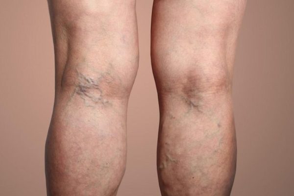 10 Cara Mencegah Varises pada Kaki 10 Cara Mencegah Varises pada Kaki