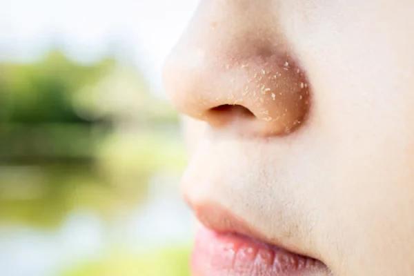 10 Tips Mengatasi Hidung Kering Secara Alami 10 Tips Mengatasi Hidung Kering Secara Alami