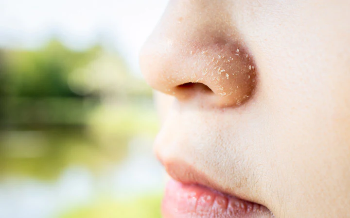 10 Tips Mengatasi Hidung Kering Secara Alami