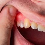 7 Herbal Alami untuk Mengatasi Gusi Bengkak