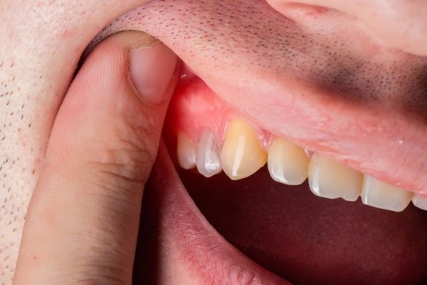 7 Herbal Alami untuk Mengatasi Gusi Bengkak 7 Herbal Alami untuk Mengatasi Gusi Bengkak