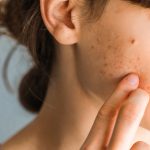 10 Tips Mengatasi Jerawat karena Ketidakseimbangan Hormon
