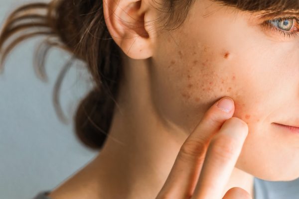 10 Tips Mengatasi Jerawat karena Ketidakseimbangan Hormon