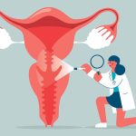 5 Cara Mendeteksi Kanker Serviks Sejak Dini