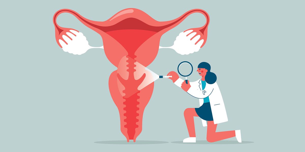 5 Cara Mendeteksi Kanker Serviks Sejak Dini