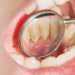 10 Cara Membersihkan Karang Gigi Tanpa Harus ke Dokter