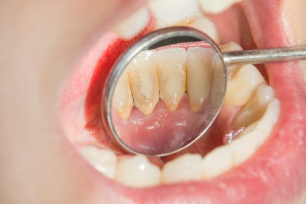 10 Cara Membersihkan Karang Gigi Tanpa Harus ke Dokter