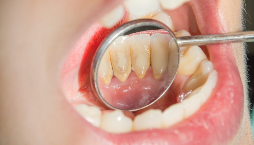 10 Cara Membersihkan Karang Gigi Tanpa Harus ke Dokter